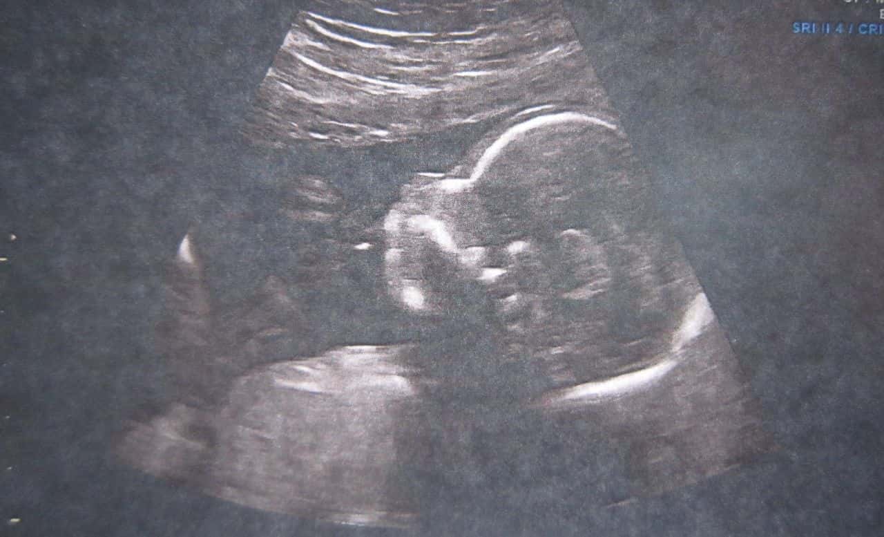 妊娠中のウルトラサウンドのイメージ